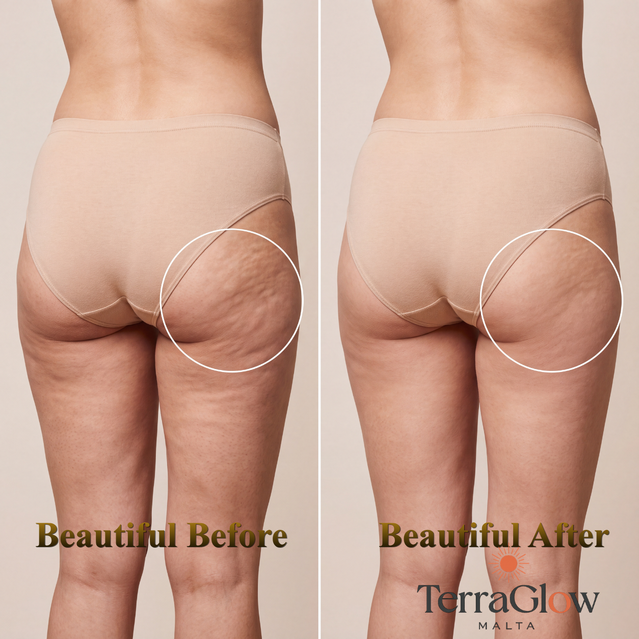 Anti-Cellulite Cream